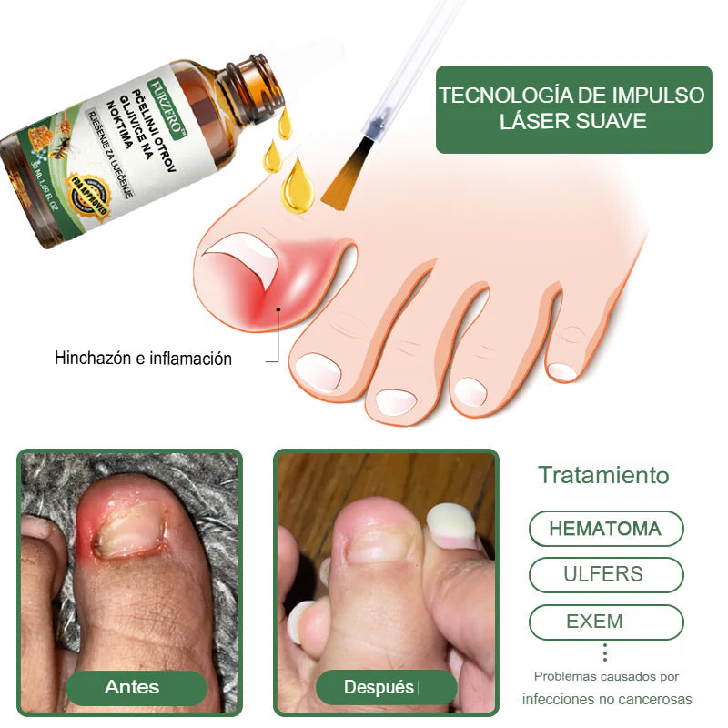 [COMPRA 1 LLEVA 2] Suero en Gotas Para Tratamiento de Los Hongos De Los Pies