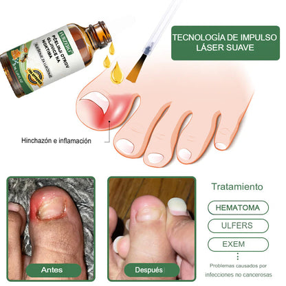 [COMPRA 1 LLEVA 2] Suero en Gotas Para Tratamiento de Los Hongos De Los Pies