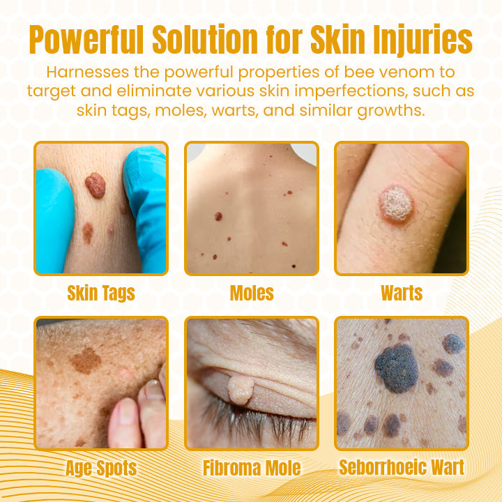 Tratamiento en aerosol multiusos con veneno de abeja Ceoerty™ Wart Remover: aprobado por dermatólogos de EE. UU.