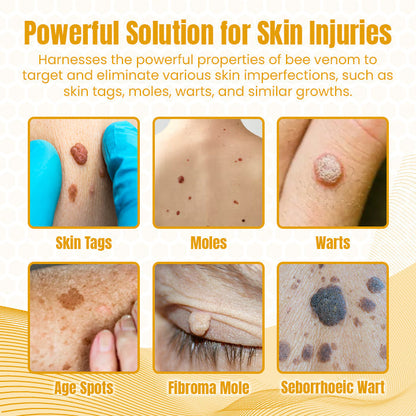 Tratamiento en aerosol multiusos con veneno de abeja Ceoerty™ Wart Remover: aprobado por dermatólogos de EE. UU.